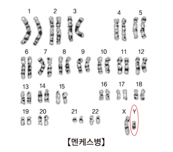 멘케스병