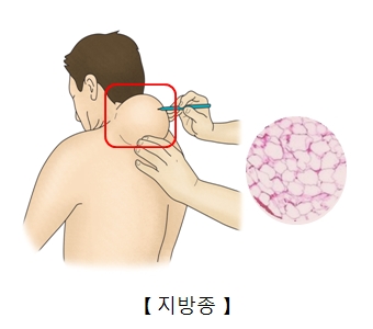 지방종