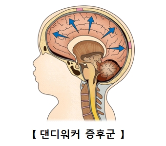 댄디워커증후군