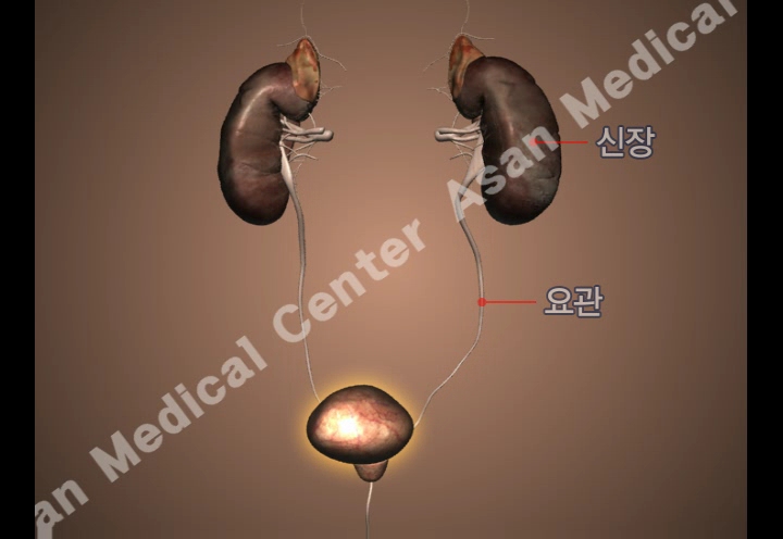 신우요관폐색