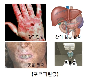 포르피린증