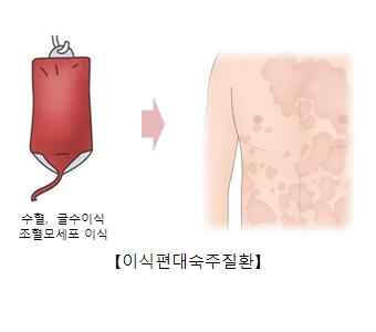 이식편대숙주질환