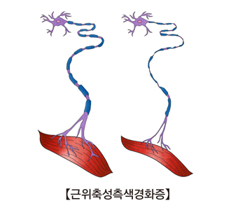 근위축성측색경화증