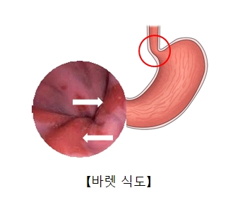 바렛식도