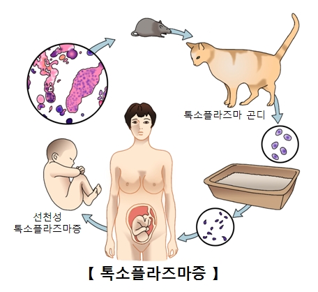 톡소플라즈마증