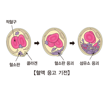 특발성 혈소판 감소성 자반증