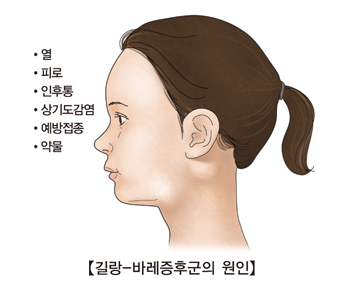 길랑-바레증후군