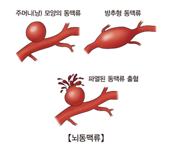 뇌동맥류