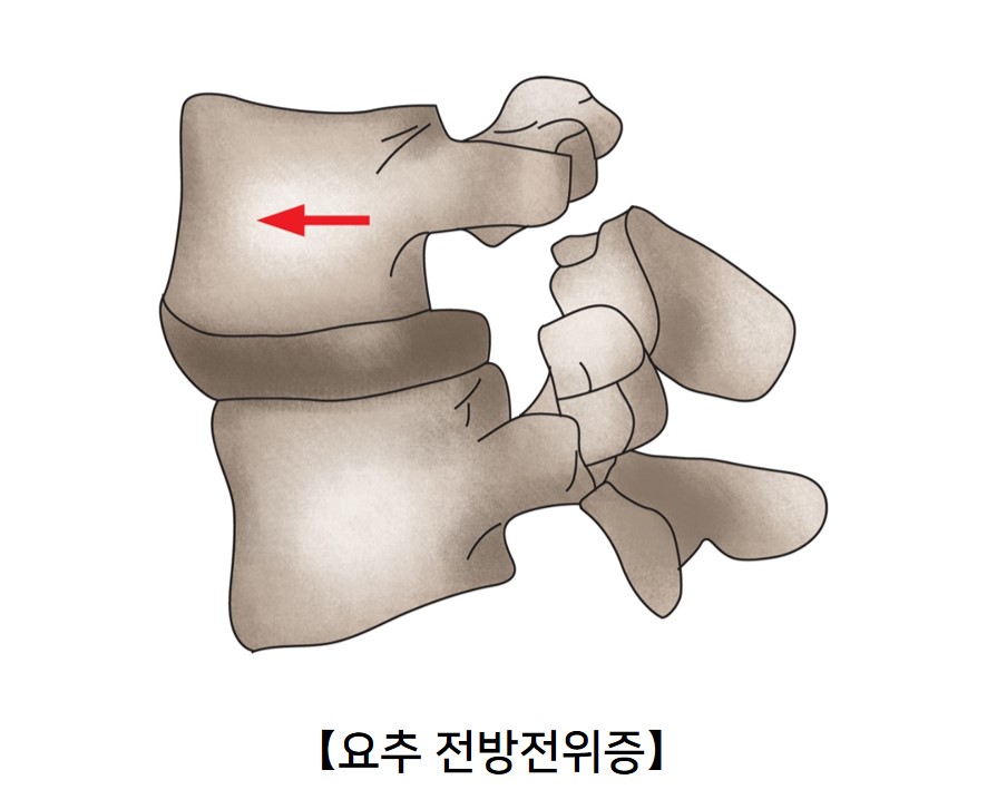 요추 전방 전위증