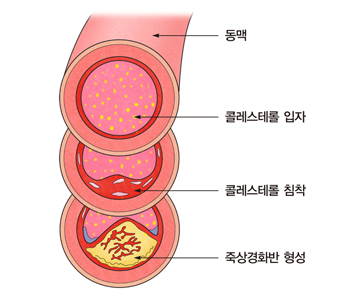 이상지질혈증