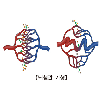 뇌혈관 기형