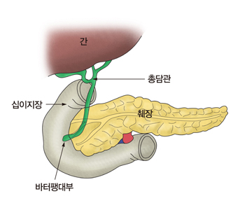 바터 팽대부 암