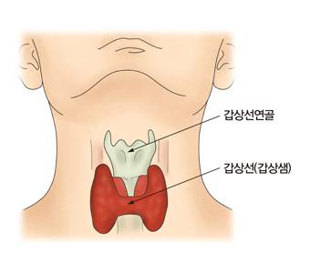 갑상선여포암