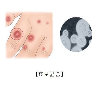 효모균증