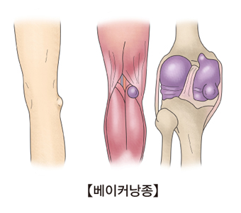 베이커낭종