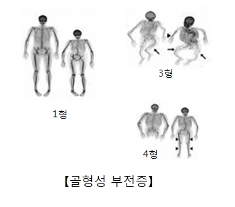 골형성부전증