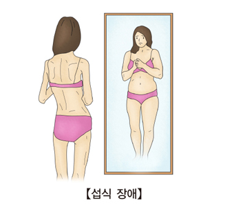 신경성 식욕부진증