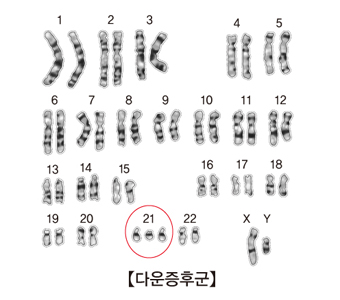 다운 증후군