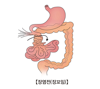 장염전