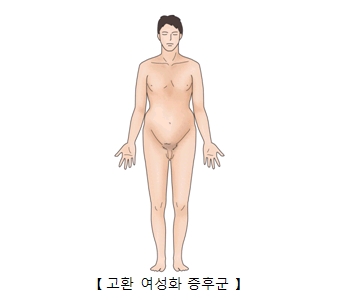 고환여성화증후군