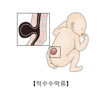 척수수막류