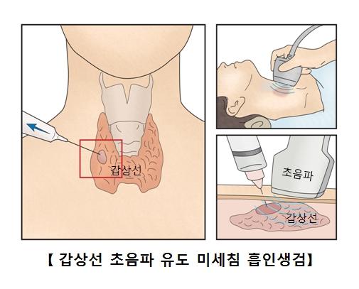 갑상선 미세침 흡인 검사를 설명하는 그림